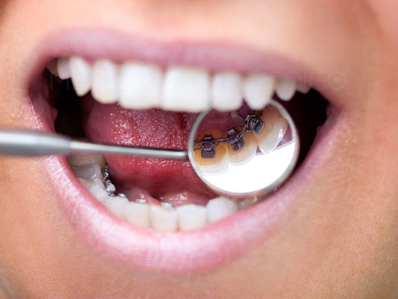 L’orthodontie linguale : un appareil discret pour les adultes